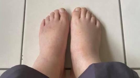 「搭飛機腿變粗」　專家一次盤點水腫成因