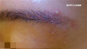 紋眉紋出逾50顆小肉芽? 妙齡女遭