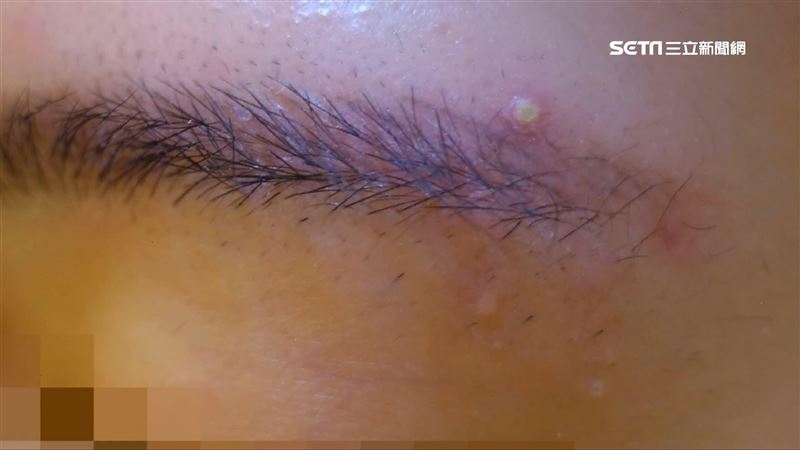 「臉部顆粒」有癌有疣　美女醫揭關鍵特徵
