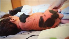 琪琪罹患「先天性巨大型黑色素痣」，全身滿是黑痣，父親節前夕專訪琪琪和父親。