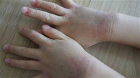 過敏,癢（圖／翻攝自photoAC）