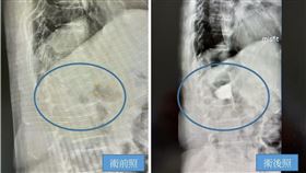 骨水泥(長安醫院)