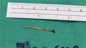 誤食魚刺不以為意　不久後「卡在肛門」(台中醫院提供)