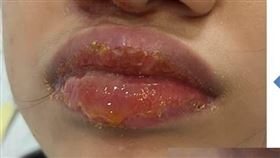 ▲小珍經口服及外用抗生素治療，後回診症狀已有改善。（圖／書田診所提供）