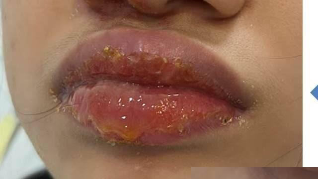 女童嘴腫痛如香腸!醫曝嚴重後果