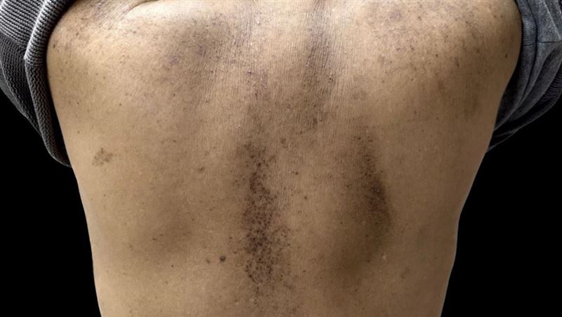 皮癢竟成蛤蟆皮　手抓、不求人是禍首