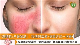 知名皮膚科診所院長周宛儀提醒，八至九成的玫瑰斑患者臉上都有蠕形蟎蟲超標的狀況。