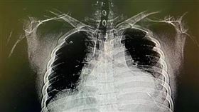 ▲36歲男在家自己針灸！「10公分針刺破心臟」針頭斷體內…3個月後才送醫（圖／翻攝自微博）