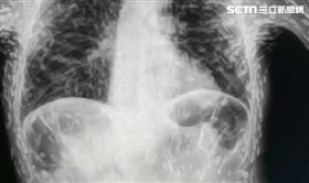 狂咳2個月！男體內一片白　醫驚：都是蟲(圖/翻攝畫面)