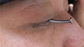 真的是「眼中釘」！他眼睛插著「6公分釘子」走進急診　醫生嚇壞(高醫提供)