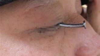 慎入！他眼睛插這1根走進急診　醫生嚇壞