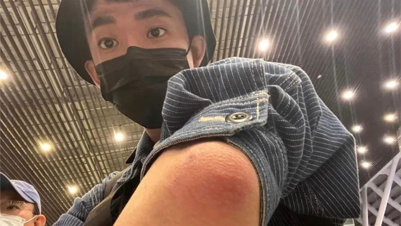 阿滴手腫成包子竟痛風！醫疑恐這病