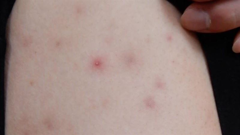 25歲女除毛紅腫痛　醫：小心蜂窩性組織炎