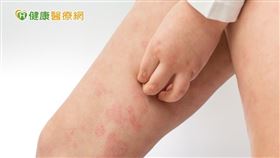 急性移植物抗宿主疾病常於皮膚出現紅腫等症狀；慢性移植物抗宿主疾病則更廣泛的侵害身體各組織。