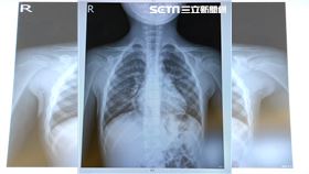 hMPV（人類間質肺炎病毒）, x光片（圖／翻攝醫心葳你Wei醫師～林智葳醫師臉書）