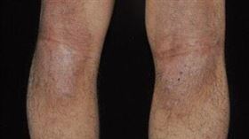 濕疹（皮膚科醫師黃毓惠提供）