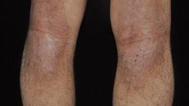 4種水果是「發物」　皮膚癢癢要少吃