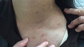 禽蟎/癢疹(北市聯醫提供)