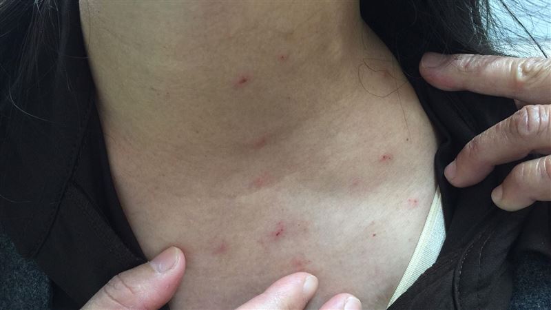 禽蟎/癢疹(北市聯醫提供)