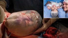 求子14年,雙胞胎,人魚寶寶,男嬰,羊膜囊