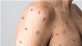 「猴痘」一名源於研究人員在1958首次在實驗室中的猴類身上發現這種病毒，被認為是囓齒動物傳播到人類身上。非洲平均每年會發生數千起猴痘案例。各地無明顯傳播鏈相關人士身上發現猴痘，表示病毒可能持續在無聲傳染中，美國CDC病毒小組科學家Andrea McCollum提醒，猴痘個案突然增加值得擔憂，雖然感染者會有明顯皮膚病灶，但是，一旦變成如新冠病毒具有無症狀傳染力時，恐使病毒源頭更難以追溯。