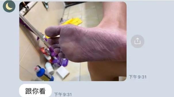 坐馬桶太久「腳底發紫」醫示警：出問題了