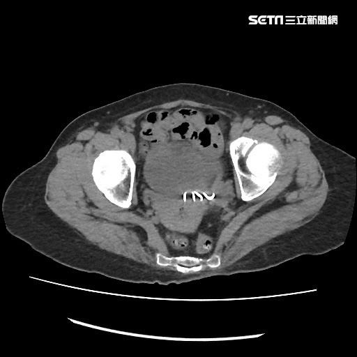 膀胱示意圖。(圖/嘉義醫院提供)