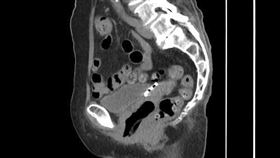嘉義,膀胱,避孕器,子宮,嘉義醫院提供