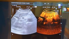 對比劑超音波檢查(門諾醫院)