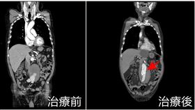 0523腹主動脈剝離動脈瘤(亞大醫院提供)