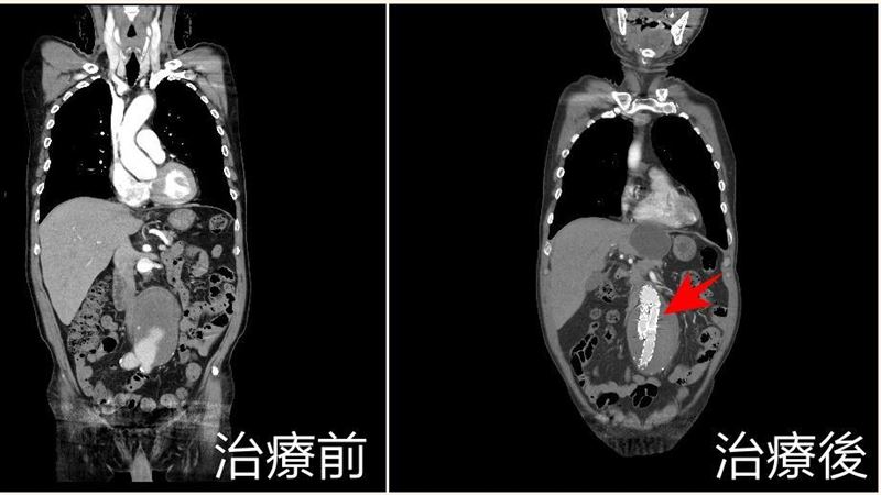 老菸槍主動脈有點大條體內竟藏2顆未爆彈
