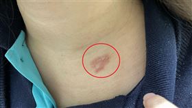 游惟勝醫師表示，帶狀疱疹好發於50歲以上以及免疫力低下的族群。（圖／烏日林新醫院提供）