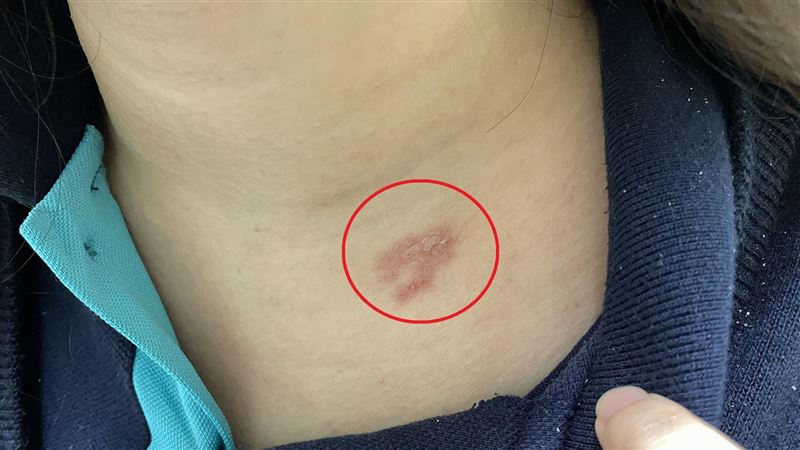 確診女長紅疹以為被蚊子叮　竟是雙重感染