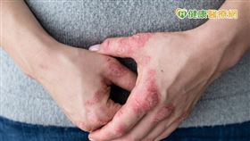 李惠婷主任呼籲乾癬性關節炎患者把握「336原則」，6個月黃金治療期重要，及早治療穩定控制疾病。