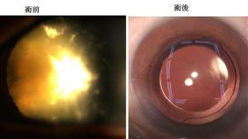 驚！17歲高中女白內障　視力不到0.01(台南醫院)