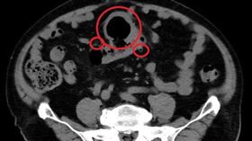 反覆腹痛逾1年才就醫　電腦斷層赫見大腸「多處憩室」(慈濟醫院提供)