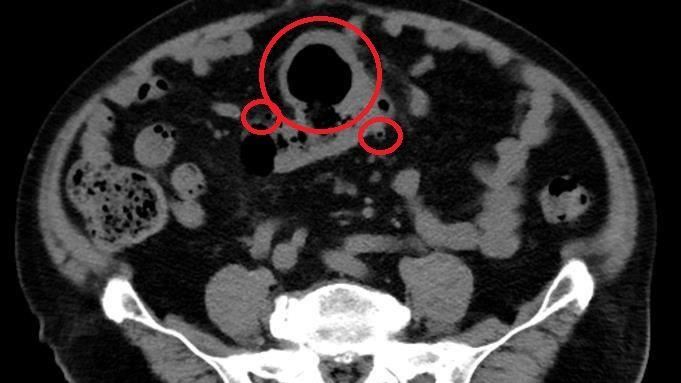 反覆腹痛逾1年才就診　醫：最大8公分了