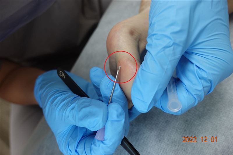 周宛儀使用無菌器械挑除毛髮。(圖/周宛儀醫師提供)