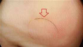 頭髮「插入」腳底　金孫腳疼阿公心疼(周宛儀醫師授權)