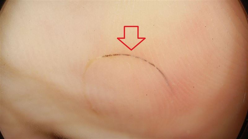 圖／你沒看錯！「1根頭髮」插入男童腳底