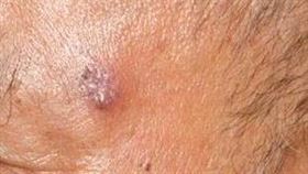 若臉上的黑斑雷射掉又長回來，小心可能是癌症。（圖／萬芳醫院提供）