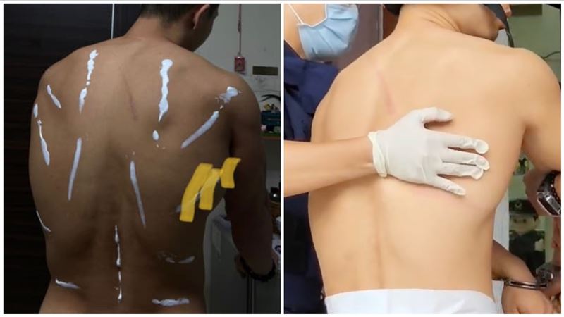 「超商浩克」曬12連擊背傷　傷勢對比圖曝