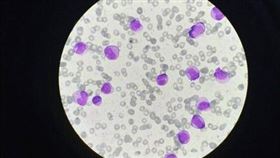 白血病／抽血檢查（醫院提供）