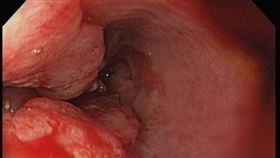 0530食道腫瘤(亞大醫院提供)