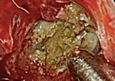 快臭死！熟男整天聞魚腥味「這疾病」上身