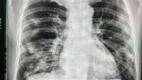 案例二：施先生肺部X光出現嚴重實質性浸潤。（圖／烏日林新醫院提供）
