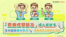 洪偉哲醫師說明，「乾癬性關節炎」屬於全身性慢性發炎性疾病，是患者自體免疫系統失控、攻擊正常細胞，造成皮膚出現乾癬以及導致關節發炎、腫脹、疼痛及僵硬。