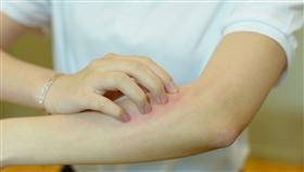 濕疹是一種常見的皮膚病，發生於任何年齡且不分性別。（圖／台北慈濟醫院提供）