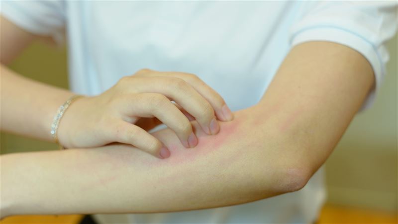 獨／冬天蕁麻疹等4病增3成！1誤區成迷思