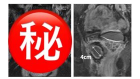 患者標靶藥物治療前(左)腫瘤約14公分大，治療後縮小至4公分(右)。 圖／長庚醫院提供)